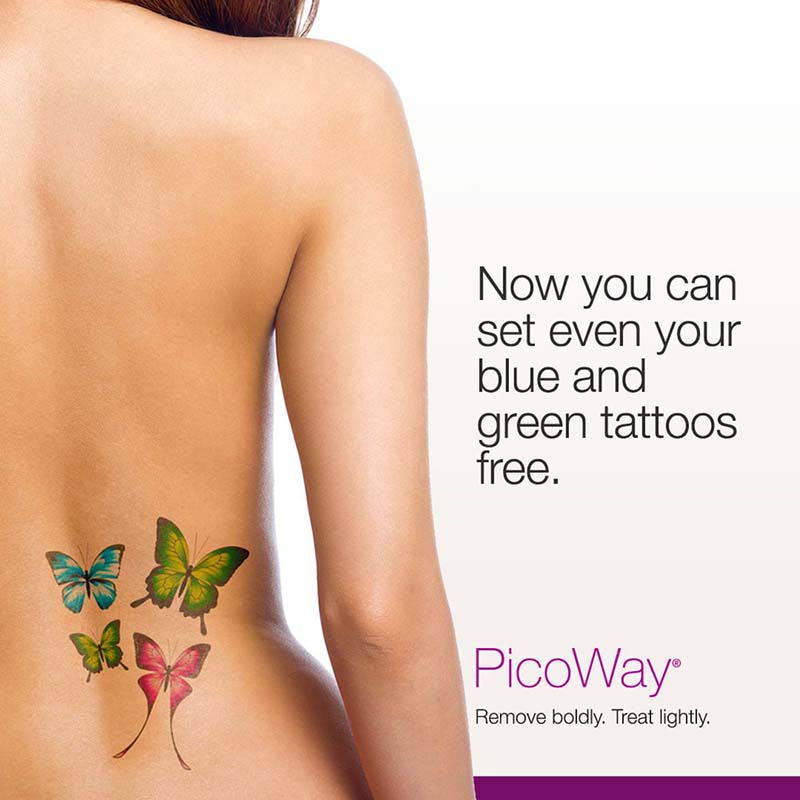 PicoWay Laser Tattoo Removal at Luminess Skin and Laser Clinic
